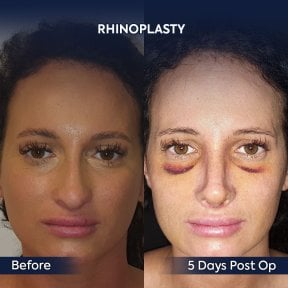 before-after photo rhinoplasty-nose-job