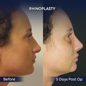before-after photo rhinoplasty-nose-job