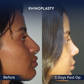 before-after photo rhinoplasty-nose-job