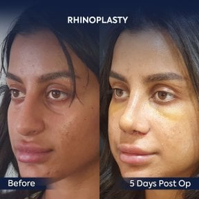before-after photo rhinoplasty-nose-job