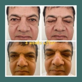 before-after photo plastika-niznego-veka