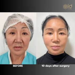 before-after photo glubokaya-podtyazhka-lica-deep-plane-facelift