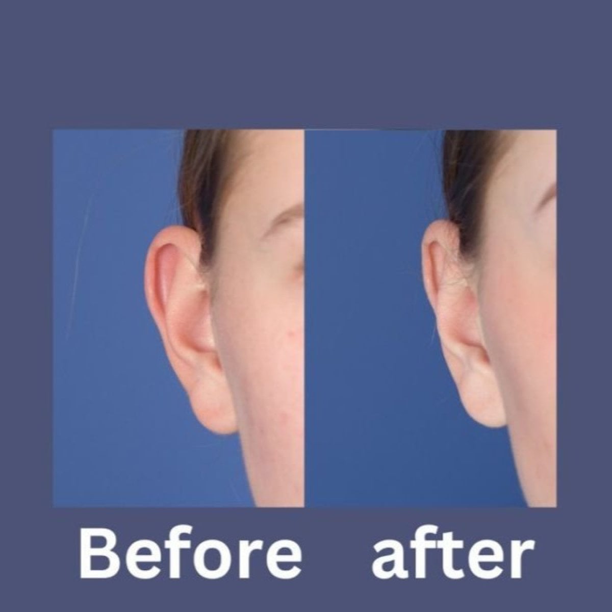 Resultados de otoplastia antes y después en ID Clinic Bangkok, mejora de forma de oreja