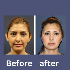 before-after photo otoplastika-plastika-usej
