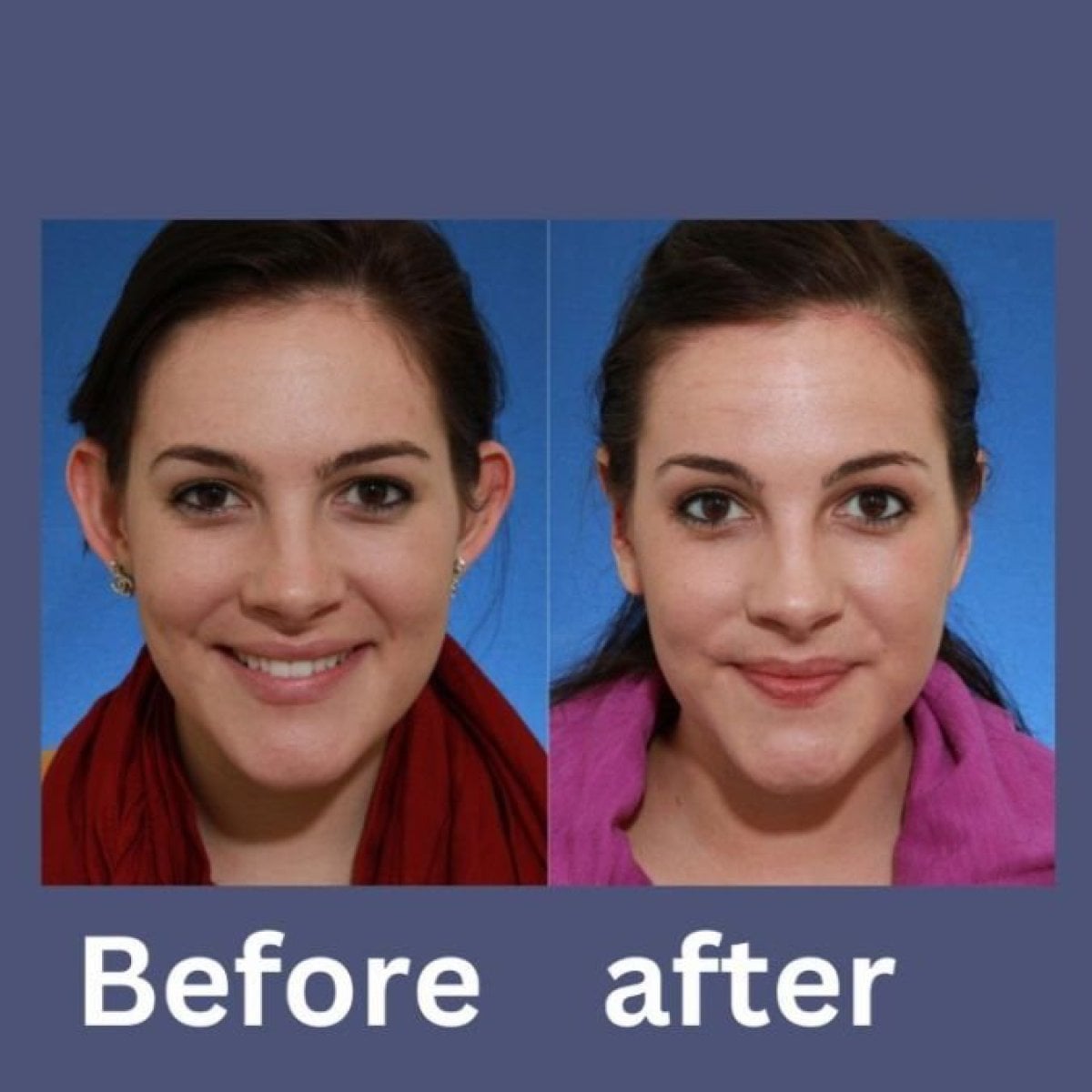 Resultados de otoplastia antes y después en ID Clinic Bangkok, orejas con aspecto natural