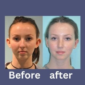 before-after photo otoplastika-plastika-usej