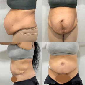 before-after photo tummy-tuck-and-liposuction