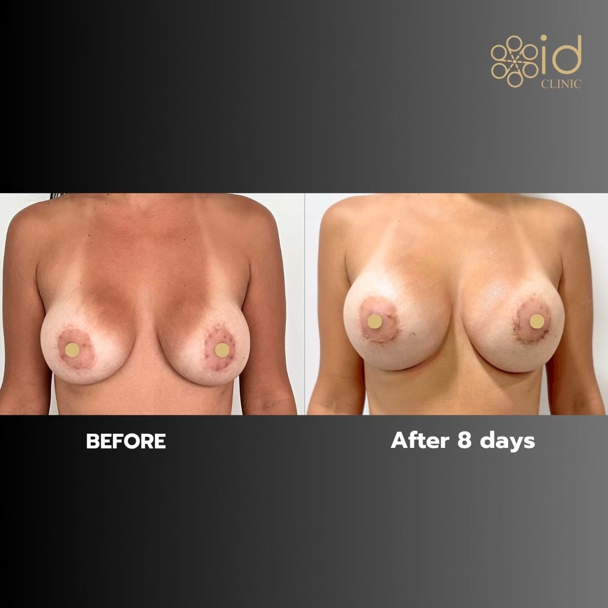 Resultados antes y después de aumento de senos con implantes de silicona en ID Clinic Bangkok, 8 días
