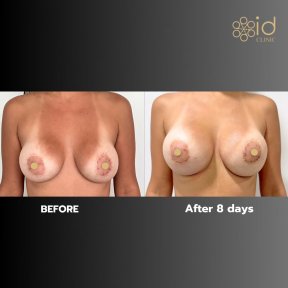before-after photo breast-augmentation-with-silicone-implants