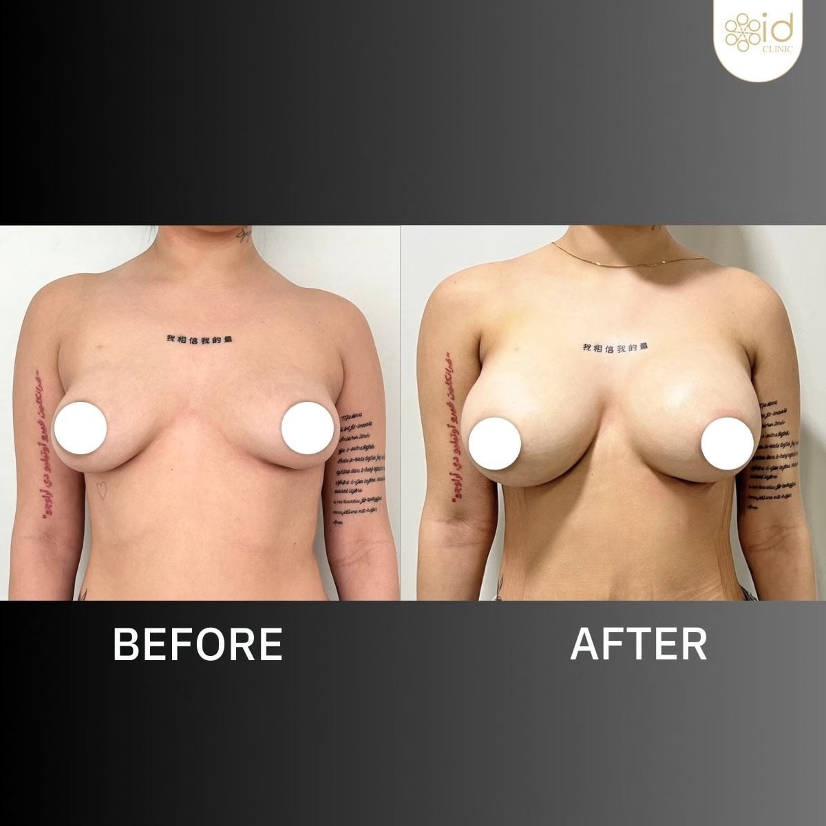 Antes y después de aumento de senos con implantes de silicona en ID Clinic Bangkok, resultados visibles