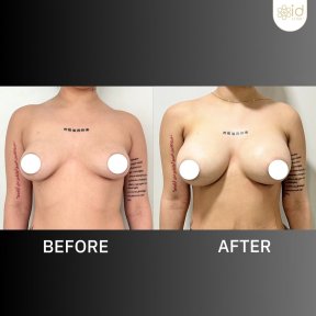 before-after photo breast-augmentation-with-silicone-implants