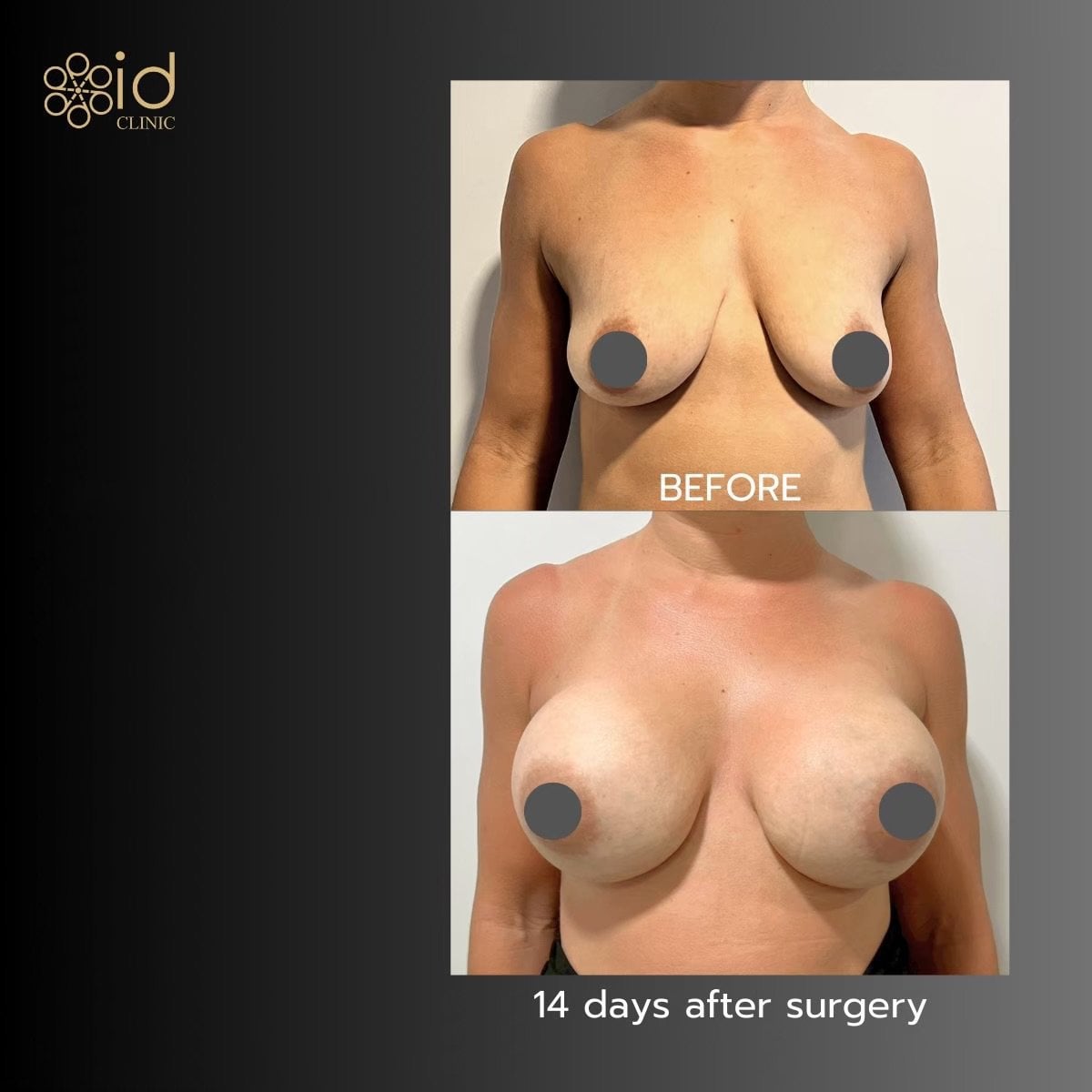 Resultados antes y después de aumento de senos con implantes de silicona en ID Clinic Bangkok
