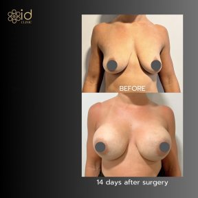 before-after photo breast-augmentation-with-silicone-implants