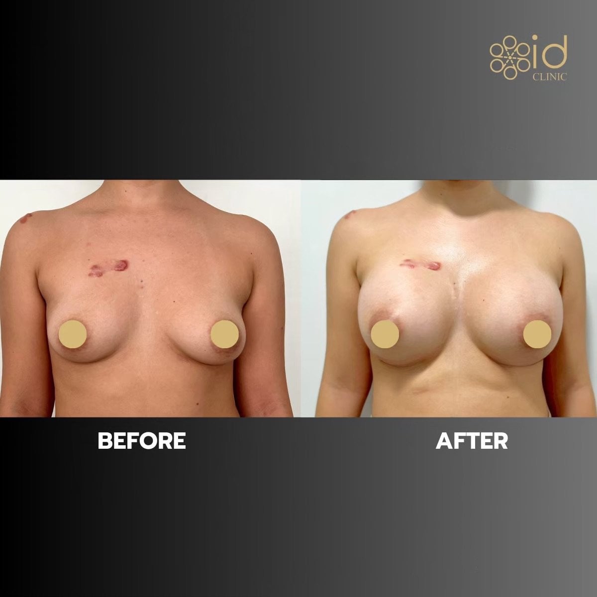 Antes y después de aumento de senos con implantes de silicona en ID Clinic Bangkok, resultados visibles