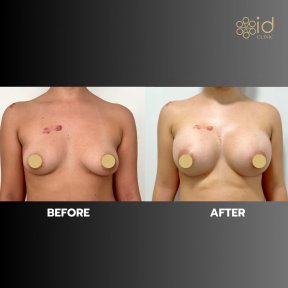 before-after photo breast-augmentation-with-silicone-implants