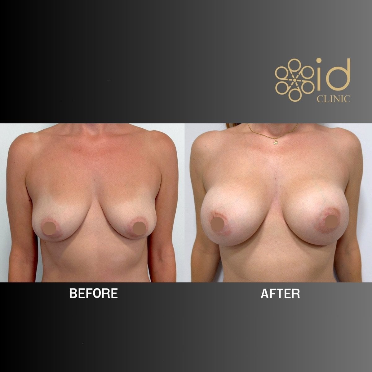 Antes y después de aumento de senos con implantes de silicona en ID Clinic Bangkok, resultados