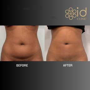 before-after photo vaser-liposuction