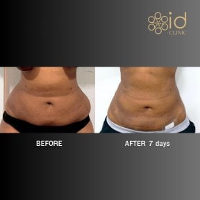 before-after photo vaser-liposuction