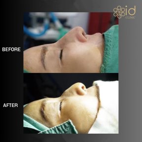 before-after photo rhinoplasty-nose-job