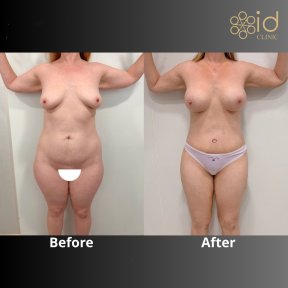before-after photo uvelicenie-grudi
