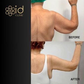 before-after photo plastika-ruk-brahioplastika