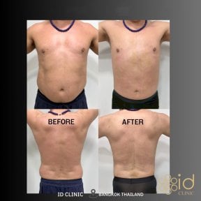 before-after photo 360-liposuction