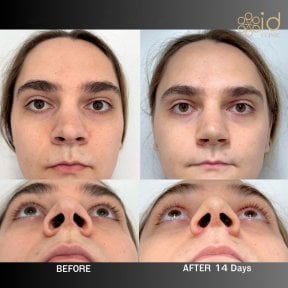 before-after photo rinoplastika-koncika-nosa