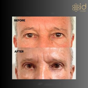 before-after photo plastika-verhnego-veka