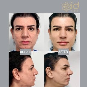 before-after photo rinoplastika-koncika-nosa