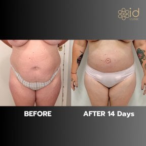 before-after photo abdominoplastika