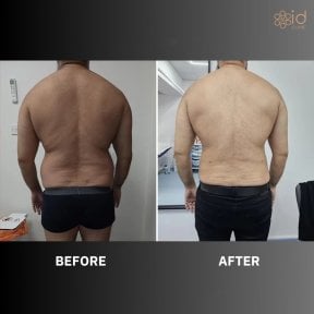 before-after photo 360-liposuction
