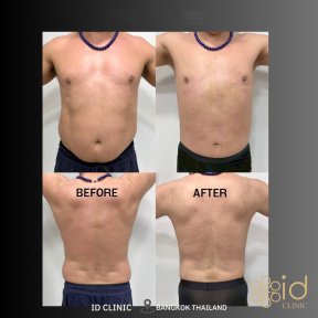 before-after photo abdominal-liposuction