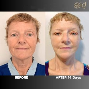 before-after photo blefaroplastika-korrekciya-vek
