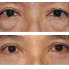 before-after photo upper-and-lower-eyelid-surgery