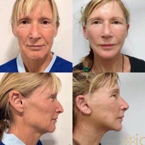 before-after photo platizmoplastika-podtazka-sei