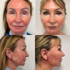 before-after photo platizmoplastika-podtazka-sei