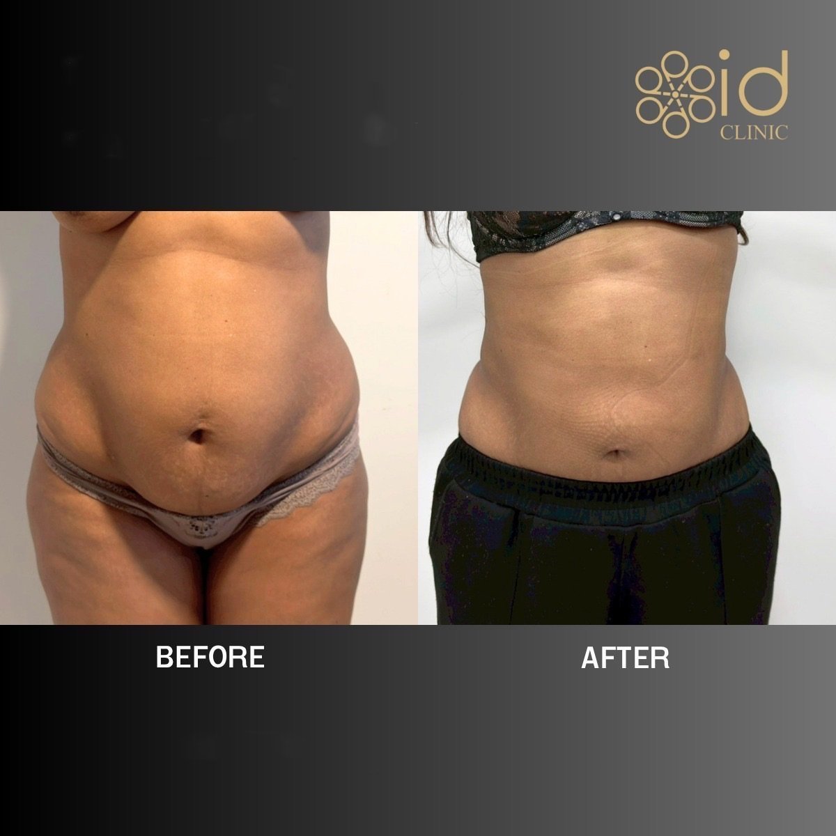 Resultados de liposucción 360 antes y después en ID Clinic Bangkok, cintura mejorada visible
