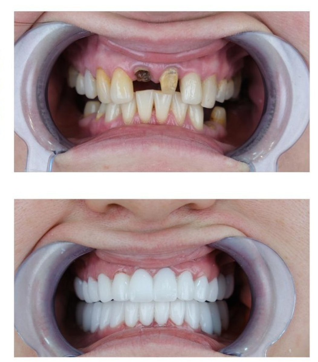 Resultado antes y después de implantes dentales All-on-4 en un día, sonrisa restaurada
