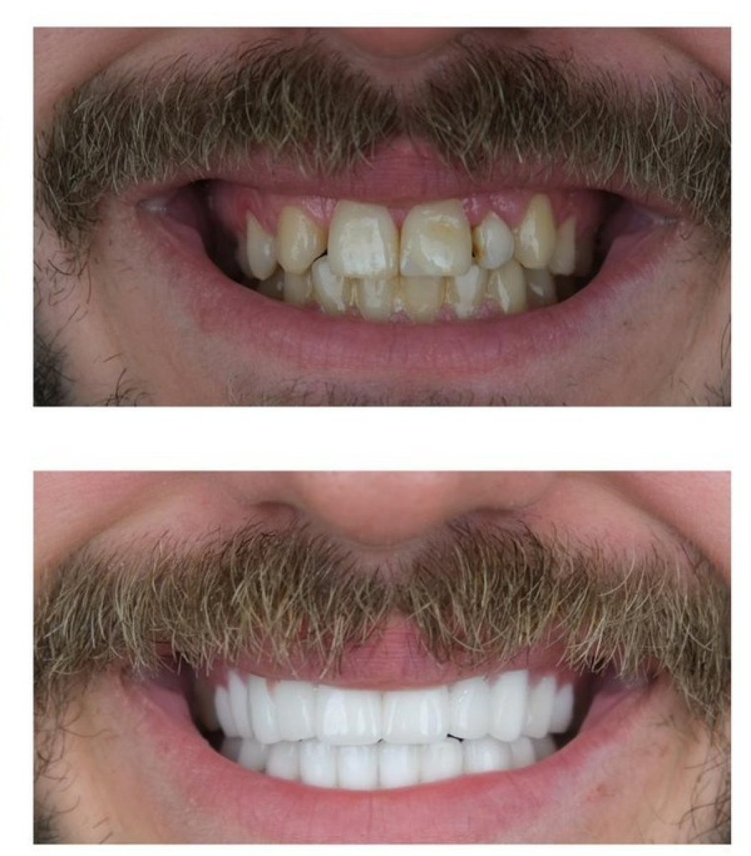 نتائج قبل وبعد تجميل الابتسامة – تحسين ترتيب وتبييض الأسنان