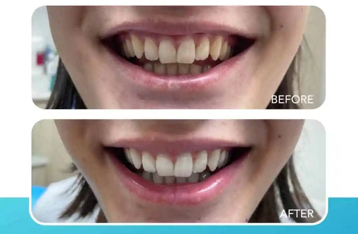 Resultados de blanqueamiento dental antes y después: sonrisa visiblemente más brillante
