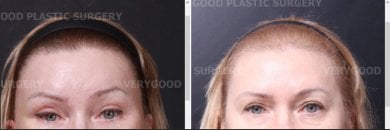 before-after photo lower-eyelid-surgery