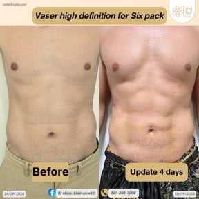 قبل وبعد شفط الدهون 360 Vaser لعضلات البطن في ID Clinic Bangkok، نتيجة عضلات واضحة
