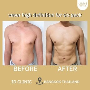 قبل وبعد شفط الدهون 360 في ID Clinic Bangkok – عضلات بطن محددة ونتيجة نحت الجسم