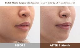 نتائج قبل وبعد رفع الشفاه ورفع زوايا الفم في عيادة Dr. Tak Plastic Surgery