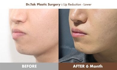 نتائج تصغير الشفة السفلية قبل وبعد في عيادة Dr. Tak Plastic Surgery بعد 6 أشهر