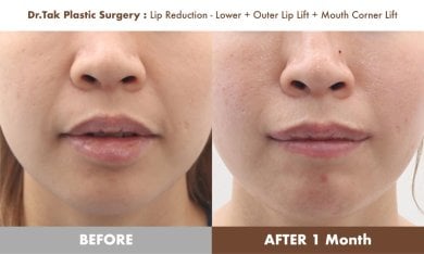نتائج قبل وبعد رفع الشفاه ورفع زوايا الفم في عيادة Dr. Tak Plastic Surgery