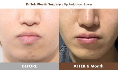 نتائج تصغير الشفة السفلية قبل وبعد في عيادة Dr. Tak Plastic Surgery بعد 6 أشهر