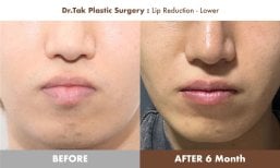 نتائج تصغير الشفة السفلية قبل وبعد في عيادة Dr. Tak Plastic Surgery بعد 6 أشهر