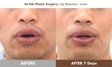 نتائج قبل وبعد تصغير الشفة السفلية في Dr. Tak Plastic Surgery، تغيير واضح في شكل الشفاه