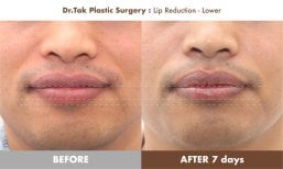 نتائج تصغير الشفة السفلية قبل وبعد في Dr. Tak Plastic Surgery، تغيير واضح بالحجم